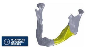 Erstes individuelles Unterkieferimplantat entwickelt