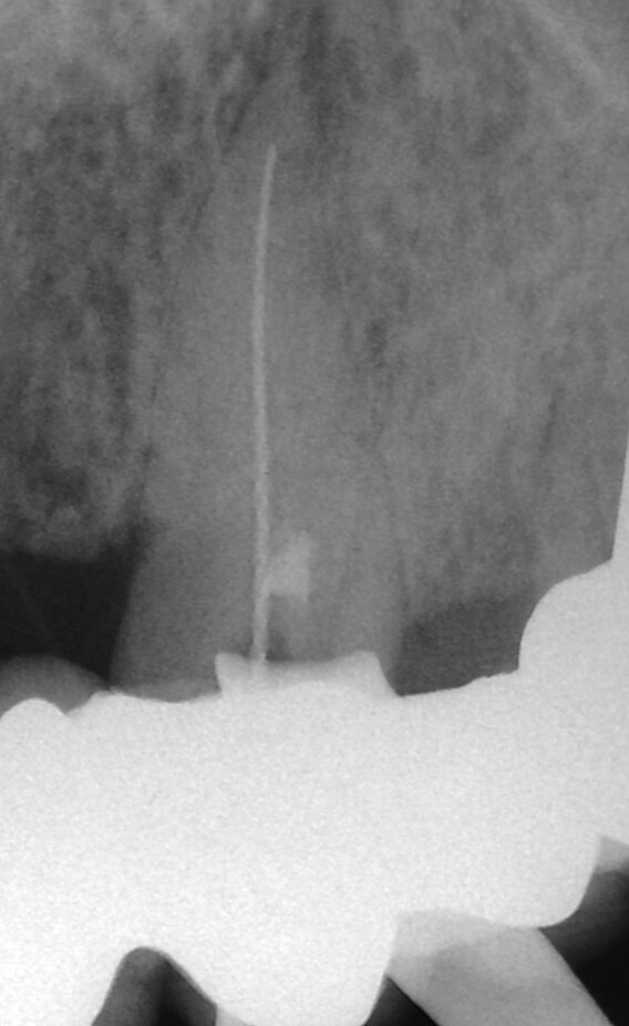 Fig. 3d: (a) Radiolucency in the cervical part of the canine. (b) Bleeding from the perforation. (c) MTA application with the MAP System and PD MTA White. (d) Original canal and repair of root perforation. (e) Post-op radiograph showing the root canal filling.