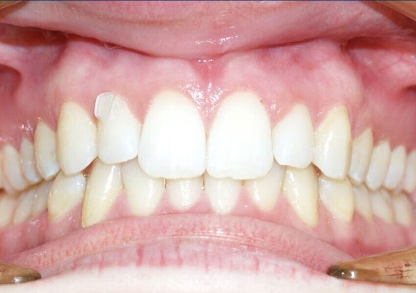 Fig. 4: Maxillary right lateral incisor requiring extrusion