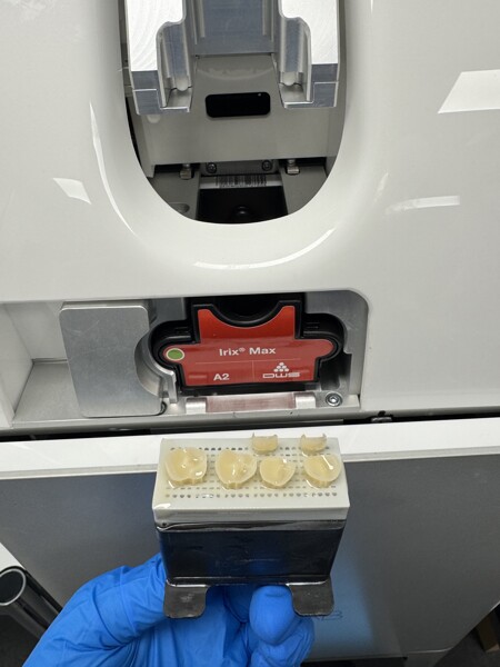 Fig. 5a: Restorations produced with the Dfab printer and Irix Max hybrid resin composite.