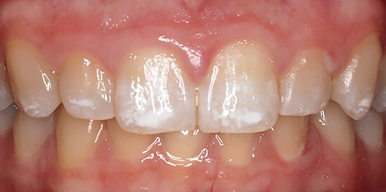 Fig. 1a: Maxillary canine to canine view. Prior to vital tooth bleaching. (All image: Drs Akimasa Tsujimoto and Ahmad Alkhazaleh)