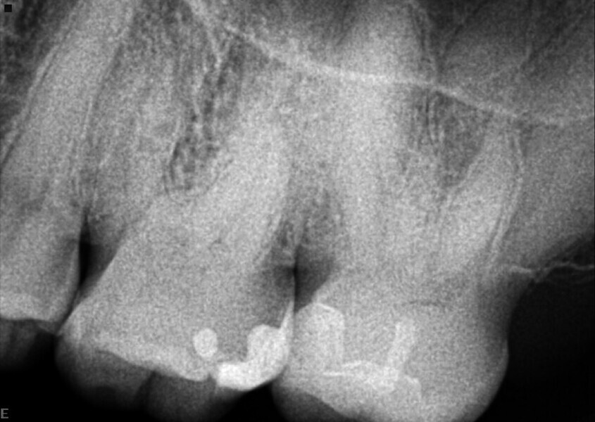 Fig. 1 : Radiographie préopératoire montrant un système de canaux radiculaires très complexe et une calcification pulpaire.