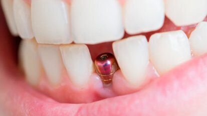 Una Consensus Conference europea di aggiornamento sugli impianti dentali