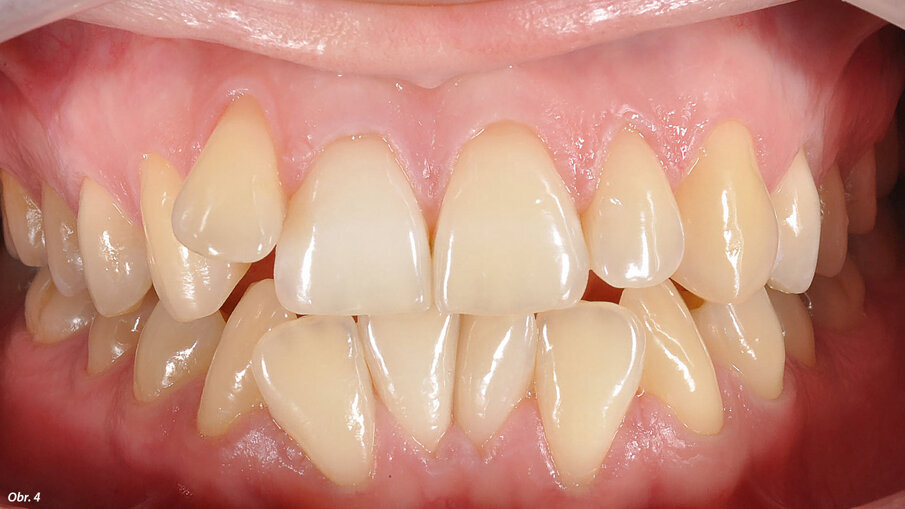EIntraorální fotografie počátečního stavu pacientky.