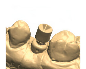 Implant Position Scanning - a Digital Impression