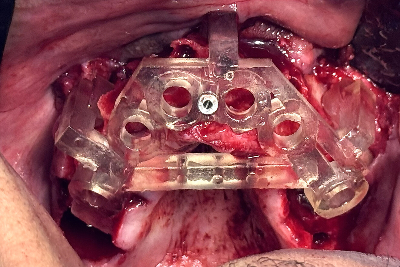 Fig. 11a: Retracted view of the nasopalatine canal pin guide seated on the maxillary bone with a single anchor pin to stabilise the guide. 