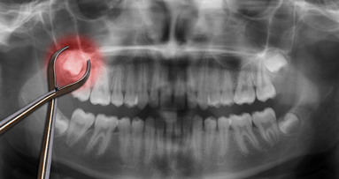 Entfernung der Weisheitszähne aus Präventionsgründen sinnvoll?