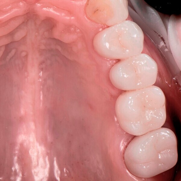 Fig. 2f: Palatal view of the gingiva after relaxation of the bleaching.