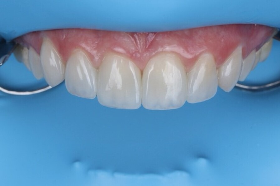 Fig. 3l: Completed direct veneer restorations on the upper incisal teeth.