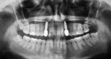 Użycie matrycy kolagenowej mucoderm® do pokrycia recesji tkanek miękkich i poszerzenia strefy dziąsła nieruchomego – opis przypadku