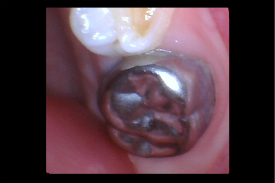 Afbeelding 11a-b. Casus 3: 23-01-20. In november met Hall-techniek geplaatste kroon met ‘50%-prognose’ om enerzijds pijn en anderzijds narcose te voorkomen.