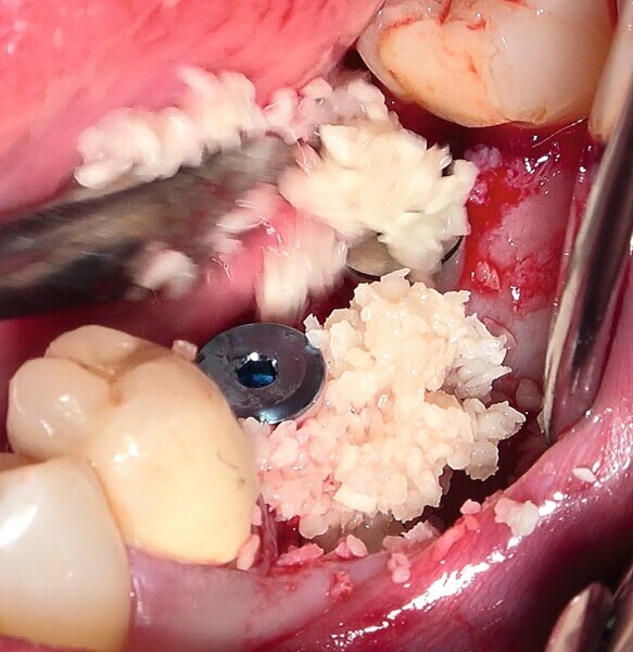 Fig. 30 : Augmentation osseuse latérale (régénération osseuse guidée) au moyen d’une allogreffe constituée d’un substitut osseux, simultanément à la pose des implants. 
