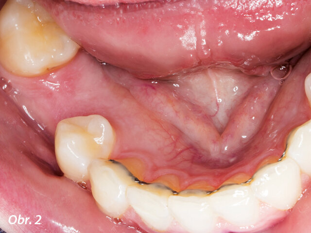 Dolní zuby pacientky před ošetřením.