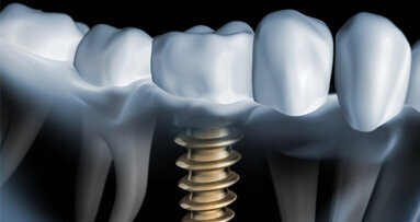 KKI: Indikationsklassen der Implantologie überarbeitet