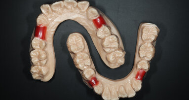 In-house 3D-printing workflows for implant restorations and Shape Memory Aligners