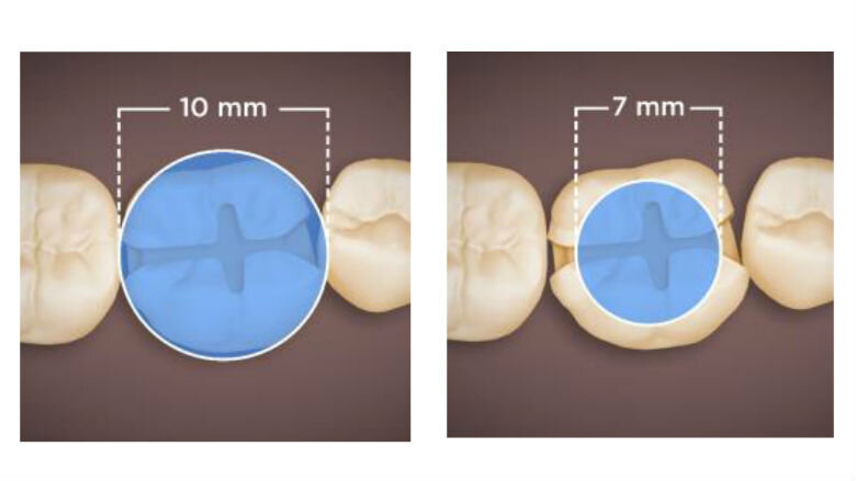 Figg. 6-7 - Confronto tra SmartLite Pro (a sinistra) e un concorrente (a destra). Ecco perché un grande diametro di emissione luminosa e un profilo di fascio omogeneo sono così importanti: comprendono tutto il materiale di riempimento e, quindi, assicurano una polimerizzazione affidabile (©Dentsply Sirona). 