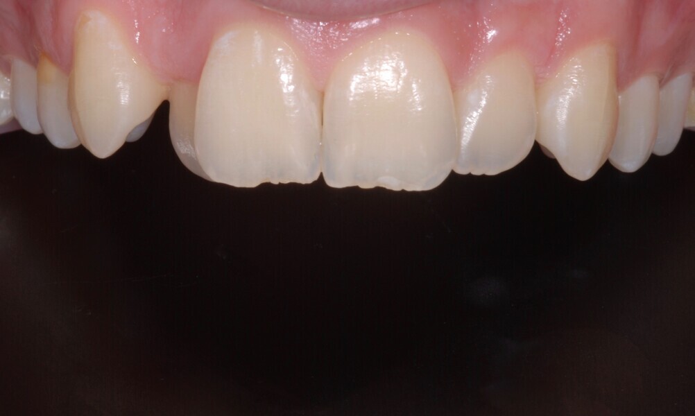 Fig. 25: Intra-oral maxillary frontal view before treatment.