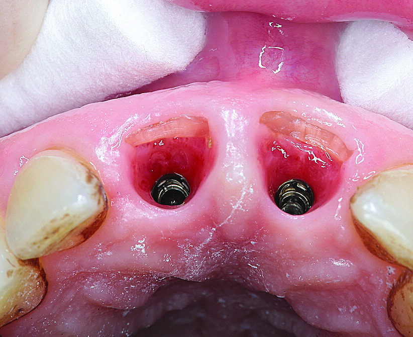 Slika 9. Dvanaest dana postoperativno: stabilne arhitektura sluznice i vestibularna ljuska