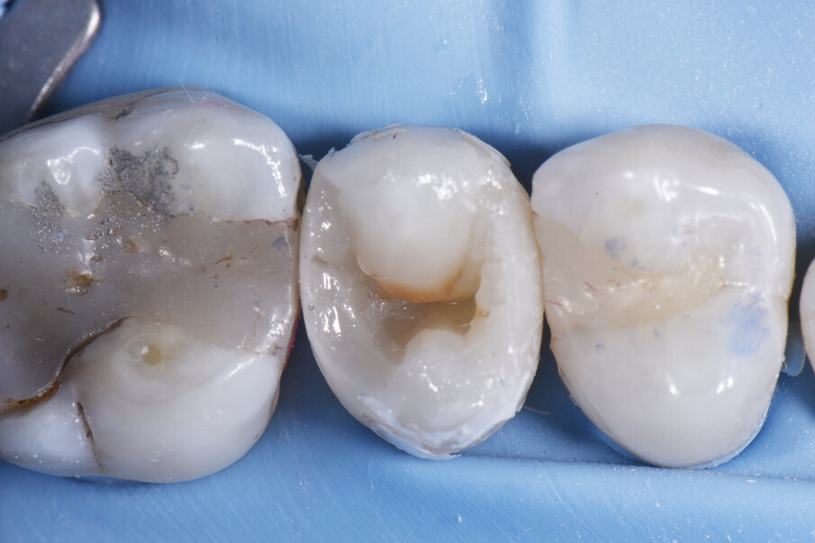 Buccal lobe placement using A2 ceram.x® SphereTEC™ one.  Fissure stain placed in interlobar position.