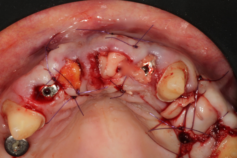 Fig. 8: Clinical situation after completion of first-stage surgery.