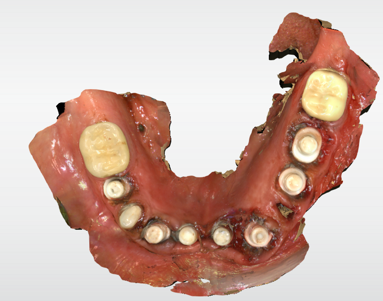 Fig. 7: Scan of the implants at the time of surgery taken with CEREC Primescan.