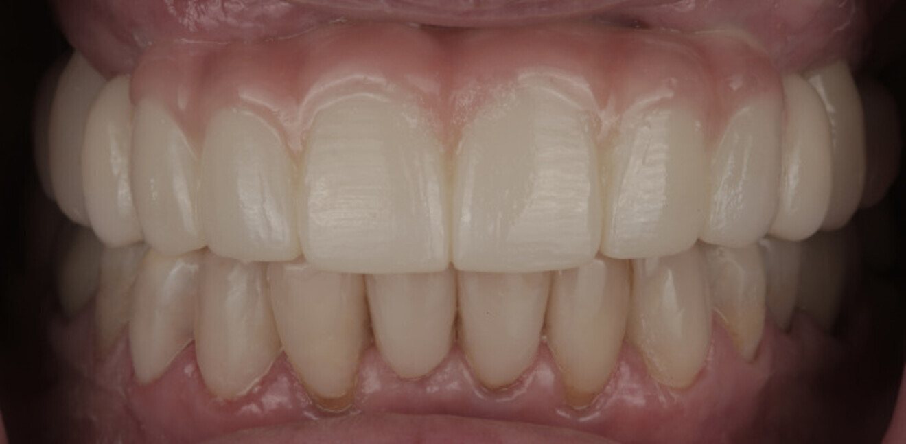 Fig. 21a: Definitive prosthesis. Intra-oral view.