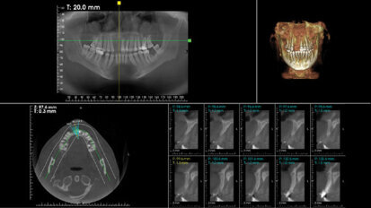 Platelets Rich Fibrin (Prf)–horizontal reconstruction of atrophic alveolar ridges, myth or reality?