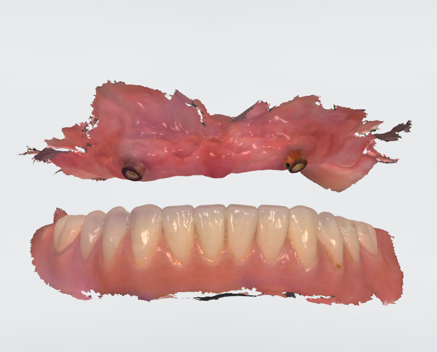 Fig. 8 - Le scansioni del rapporto intermascellare allineato nella dimensione verticale abituale della paziente.