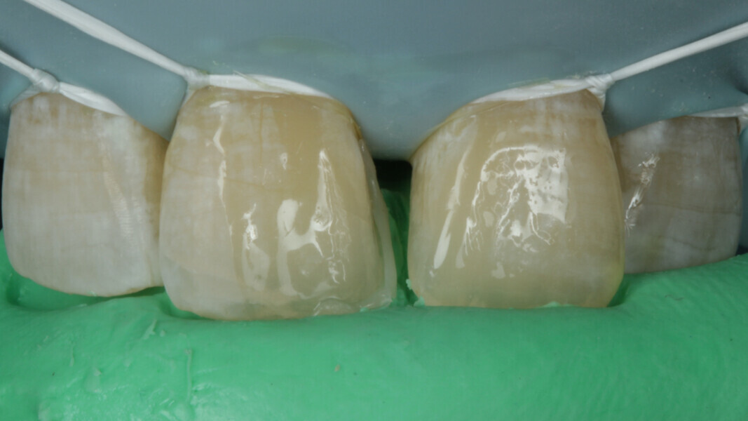 Fig 10. The silicon index is then used to build the palatal shell which will serve as the base to further layer composite.