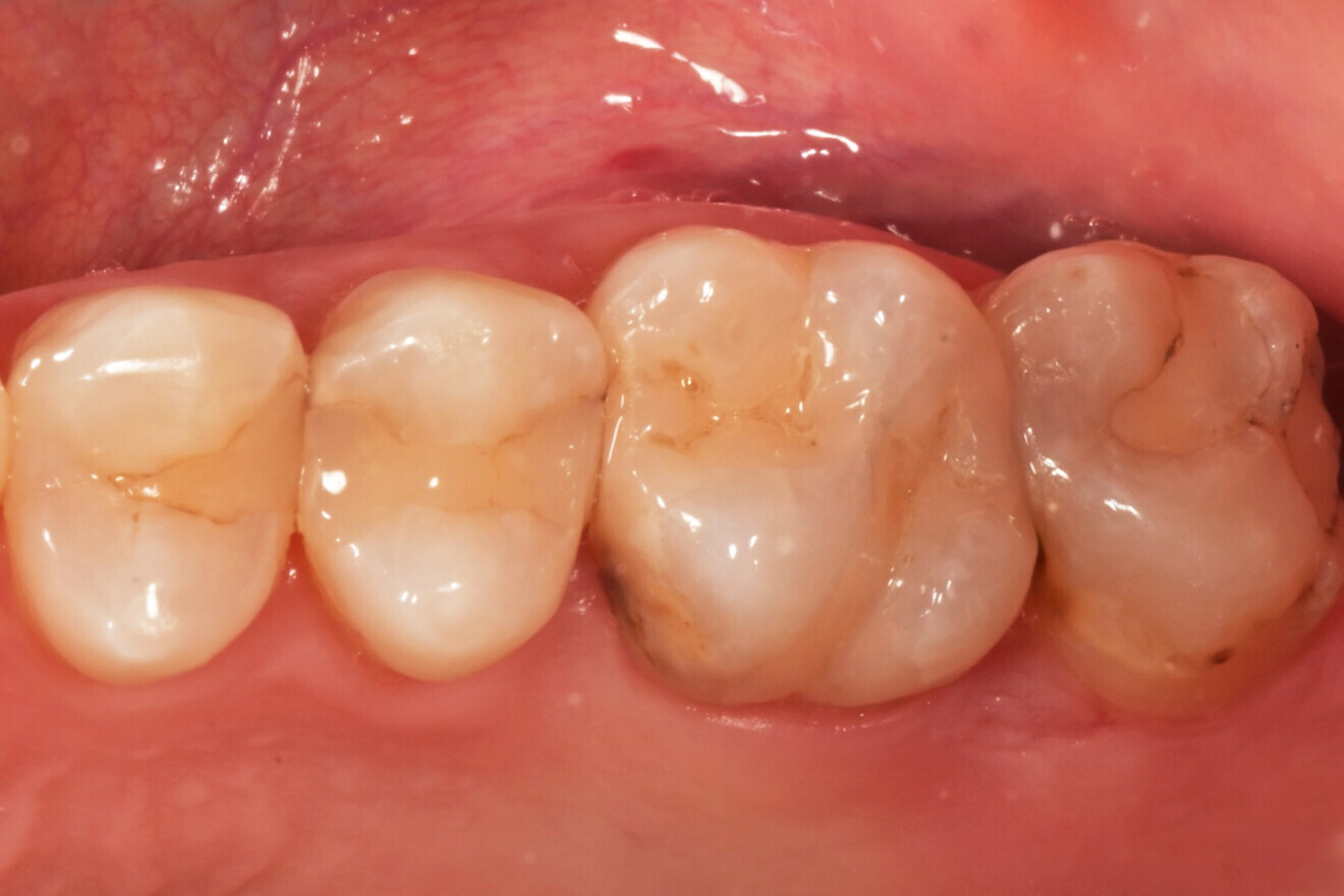 Фиг. 13 -  Bio-Bulk Fill.