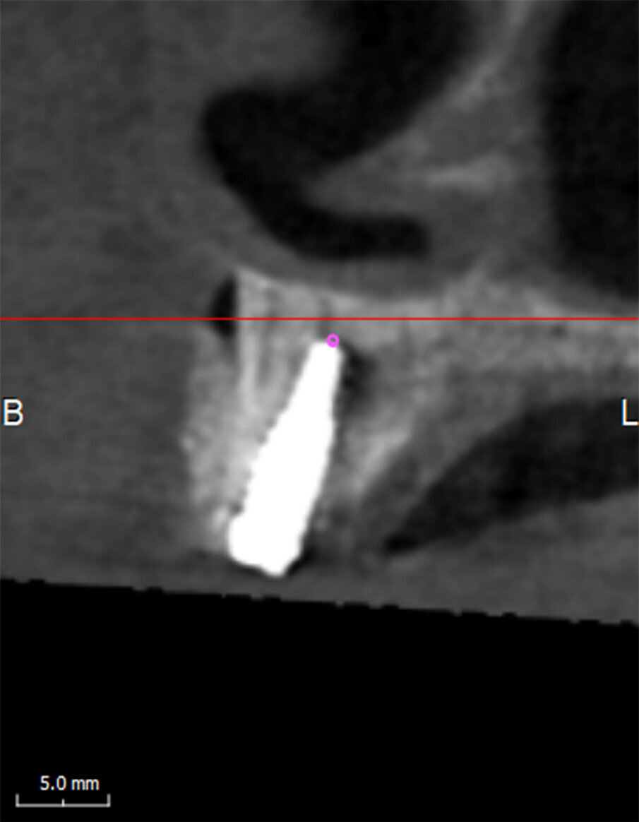 Fig. 6 - Immagine parassiale raffigurante l’impianto in sede 1.1 che comprime il CS.
