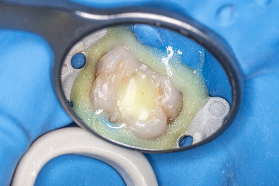 Fig. 49: The maxillary first molar with the temporary restoration before treatment.