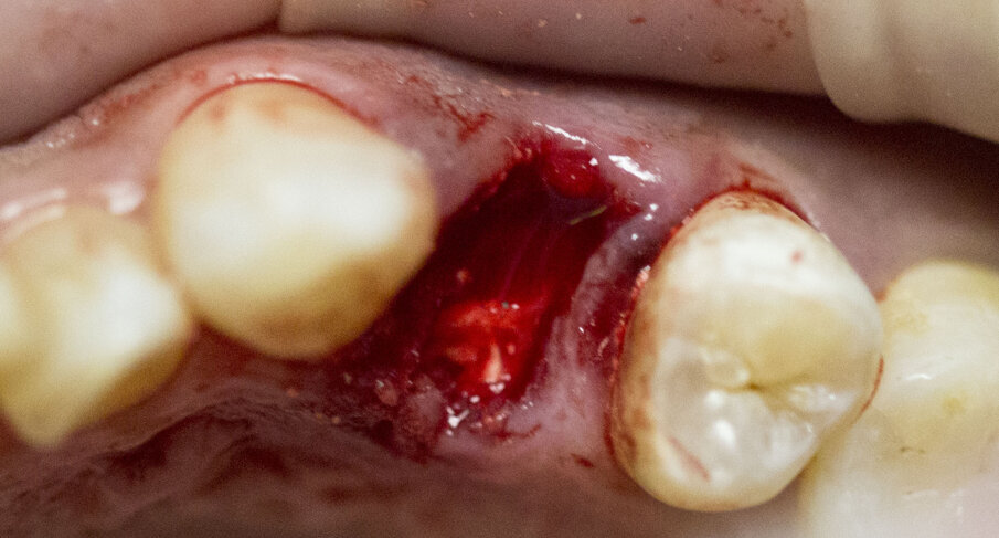 Fig. 6 - Biomateriale in situ.