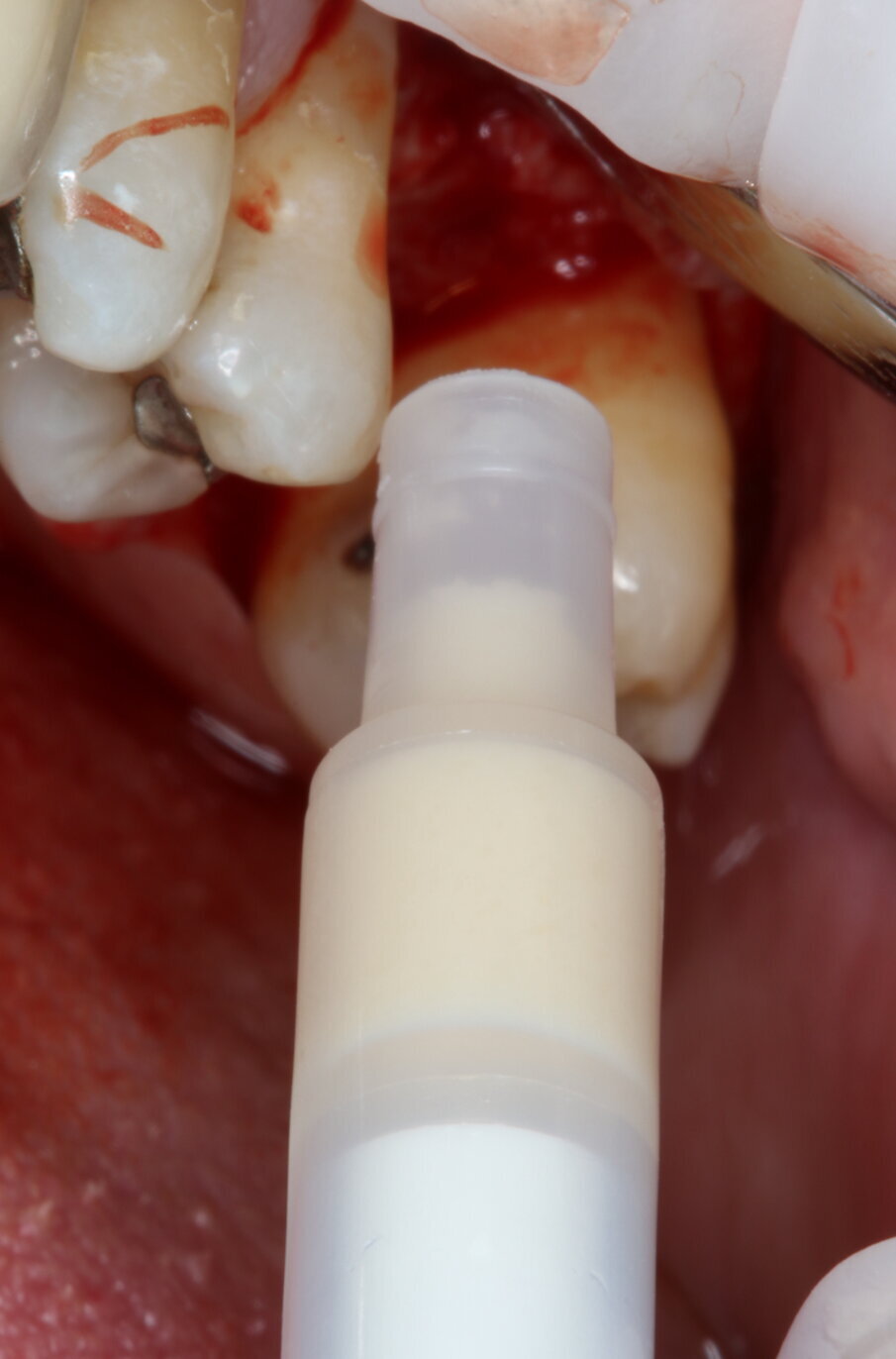 Fig. 3_Inserimento del biomateriale OsteoBiol Putty.