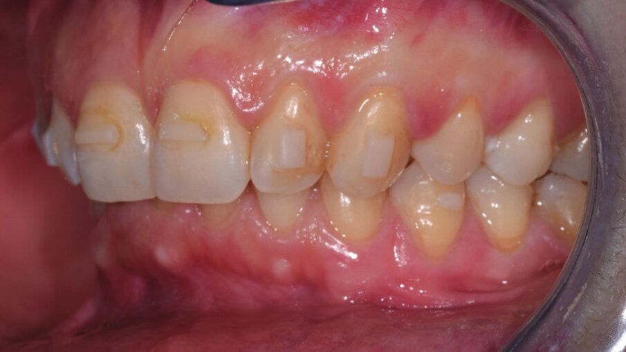 Figg. 7a-7e_Step intermedio. Lo stripping è stato eseguito con le nuove Orthostrips “Central” Intensiv. Una corretta procedura di riduzione interprossimale ci permette di recuperare spazio in arcata per ottenere la risoluzione completa dell’affollamento dentale e delle rotazioni presenti.