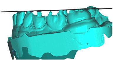 Digitální postupy pro plánování okluze se sekvenčním vedením u složitých klinických případů