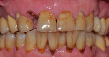 Impianti post-estrattivi immediati nei settori estetici: l’importanza della selezione del caso tramite un esame CBCT ad alta risoluzione