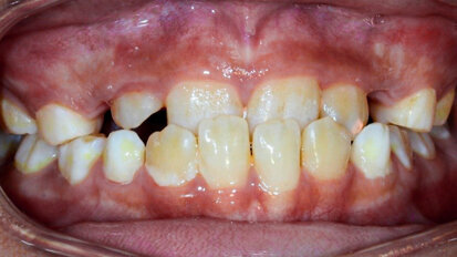 Early correction of anterior cross bite