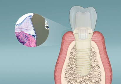 Patent Dental Implant System