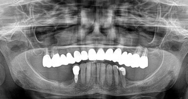 Restauro di una mandibola atrofica mediante impianti di 4,5 millimetri di lunghezza