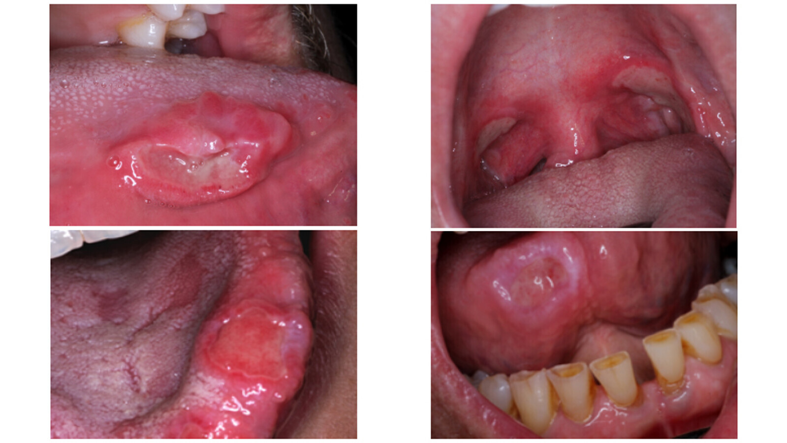 Figura 2. Las aftas mayores son lesiones de mayor diÃ¡metro, profundas, destructivas y muy dolorosas.Â 