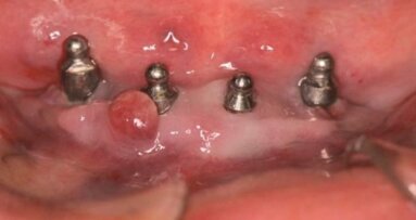 Zapalenie tkanek wokół implantu a laser Er:YAG