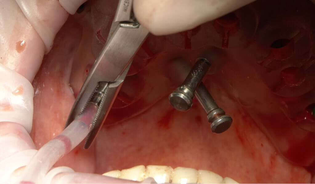 Fig. 9: Fully guided crestal approach to the sinus using the OneCAS KIT.
