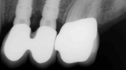 Simplified Apposition Technique, case series