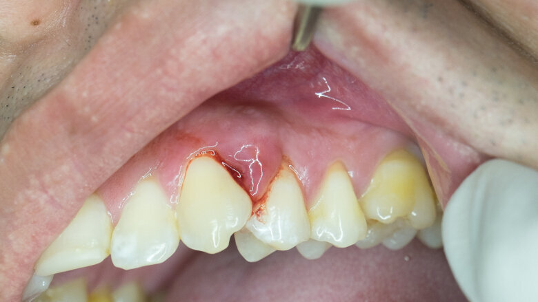 La parodontite pourrait doubler les risques de déclin cognitif, selon une étude