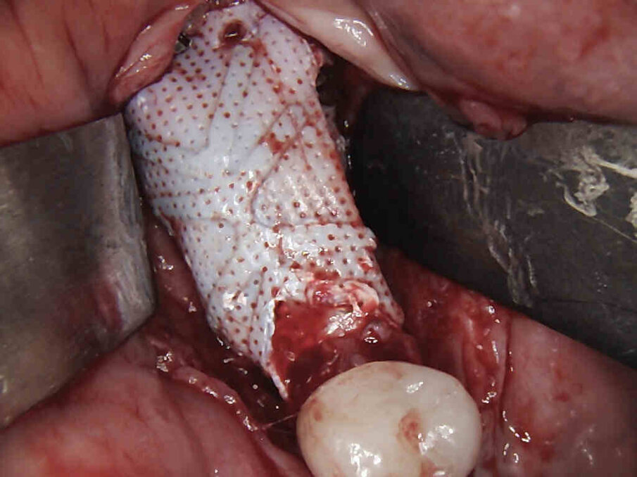 Figg. 9, 10_La situazione radiologica e clinica a 6 mesi dalla chirurgia, si esegue la riapertura attraverso una singola incisione crestale.