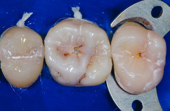 Fig. 15 : Vue occlusale pre-operatoire objectivant une lesion carieuse sur 16.
