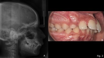 Il twin-block come stimolo funzionale alla risoluzione delle II classi scheletriche da retrusione mandibolare