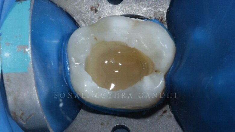 Fig 8: Ready for composite restoration