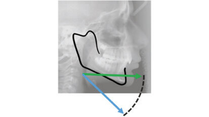 Moderate to severe Class II  malocclusion using Invisalign® treatment with mandibular advancement